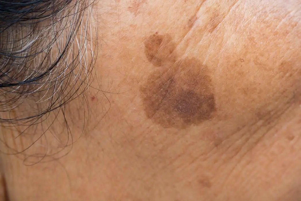 pigmented lesion