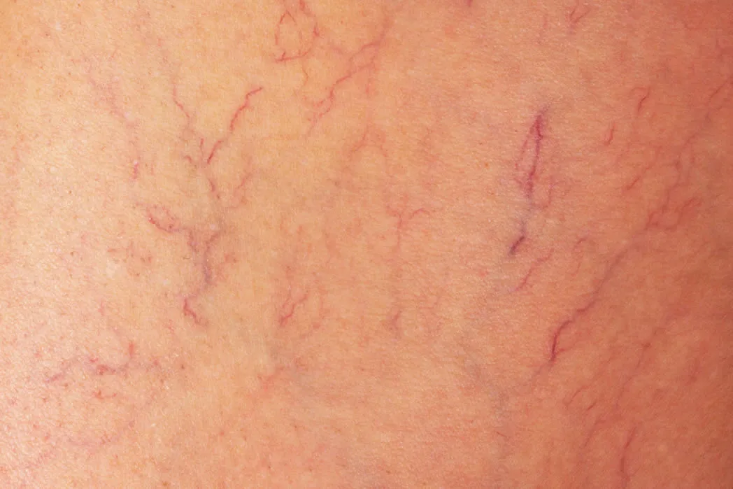 vascular lesions beautiful-woman-perlane-dermatology