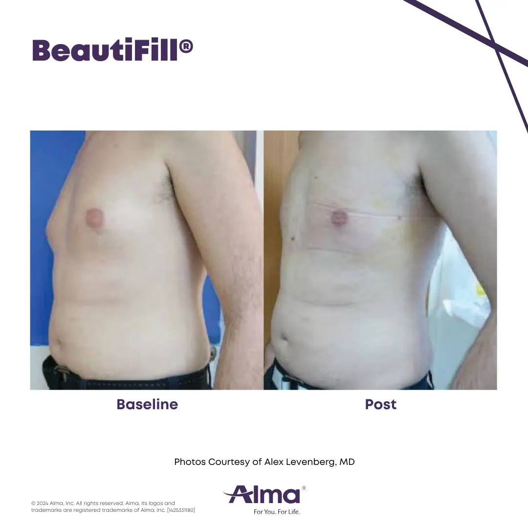 BeautiFill_BA_D