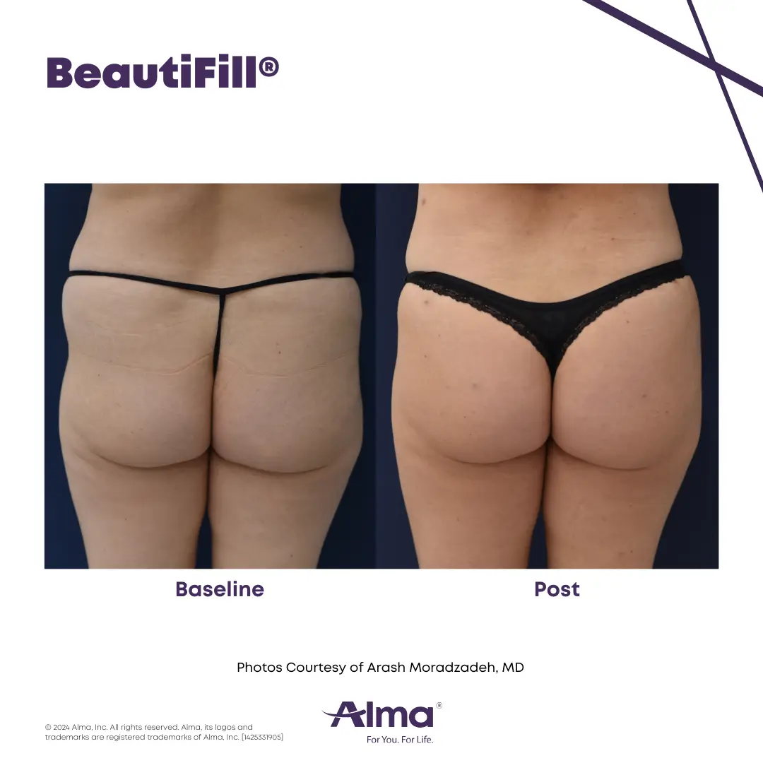 BeautiFill_BA_D