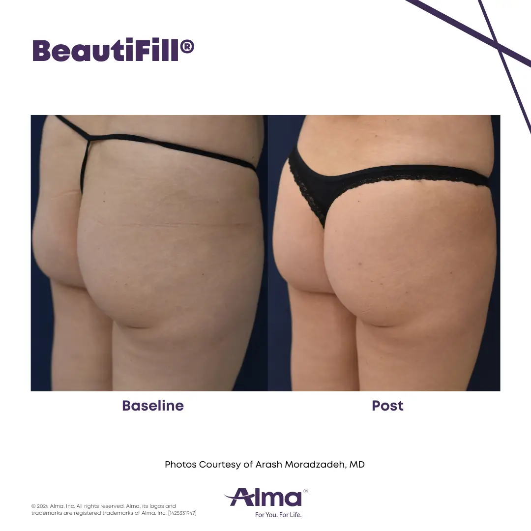 BeautiFill_BA_J