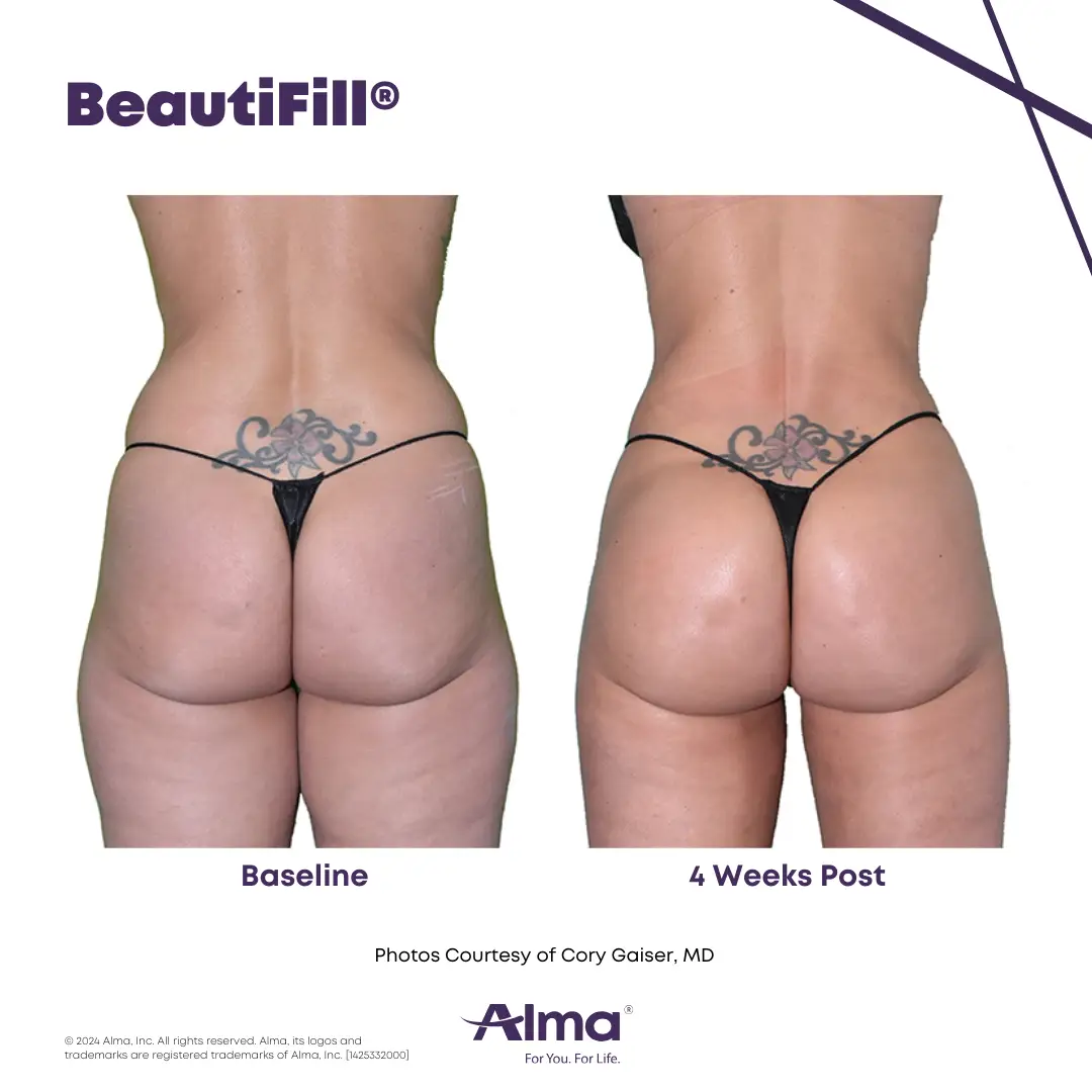 BeautiFill_BA_J