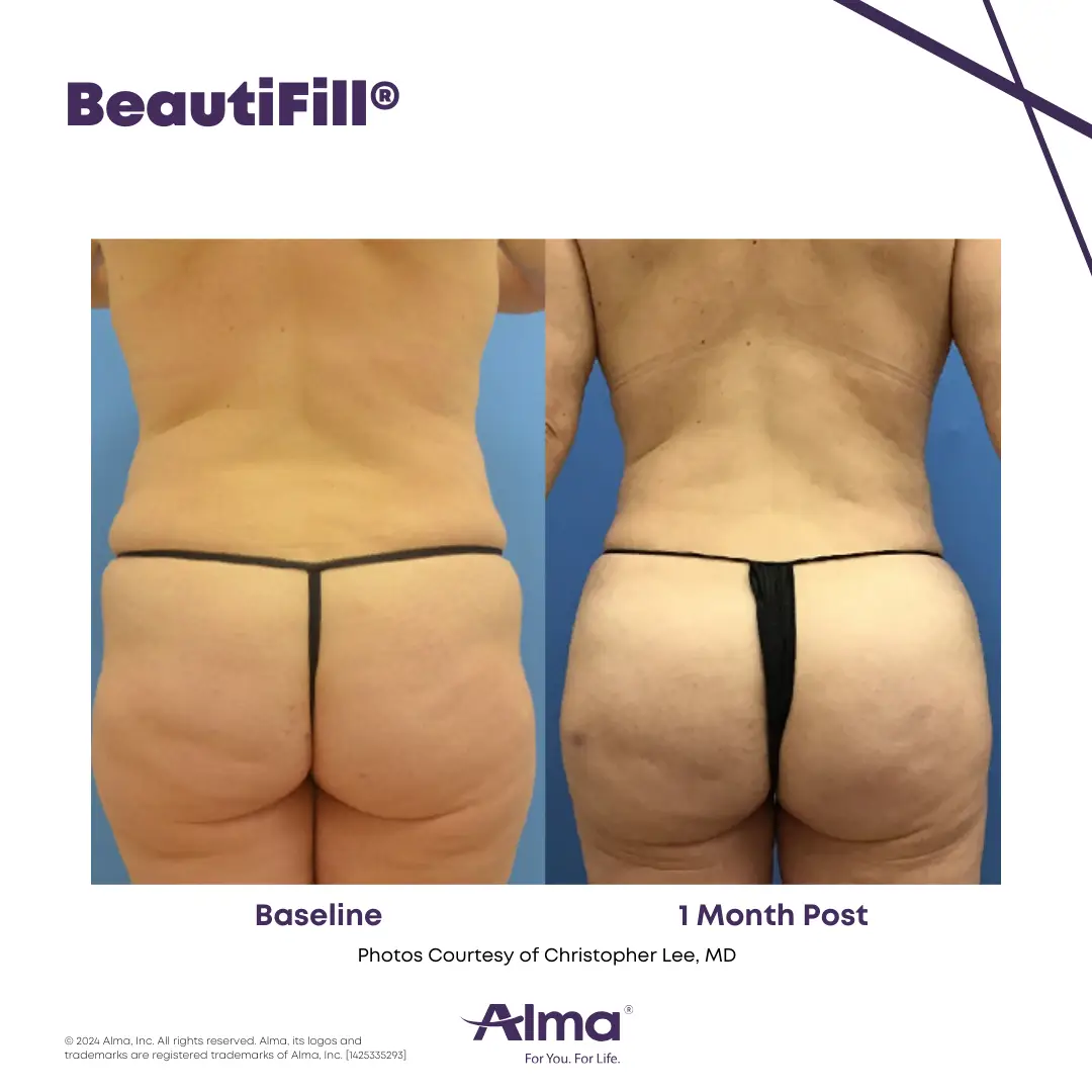BeautiFill_BA_D