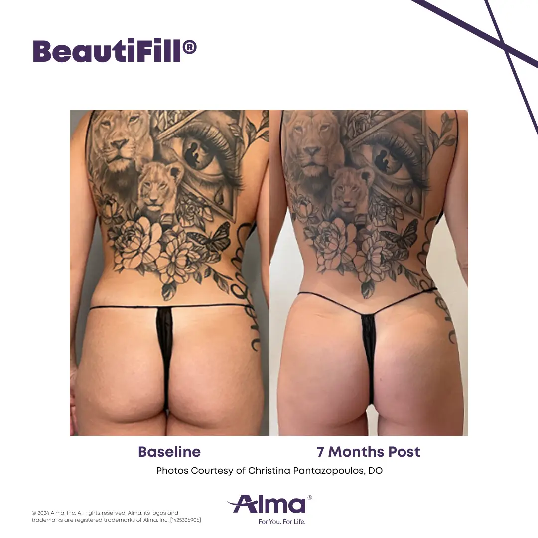 BeautiFill_BA_J