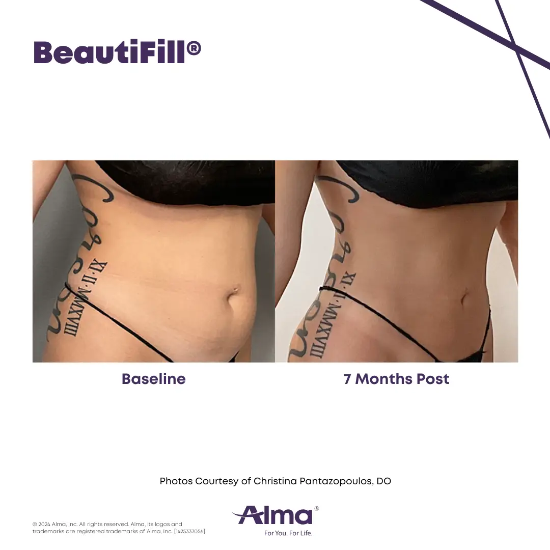 BeautiFill_BA_J