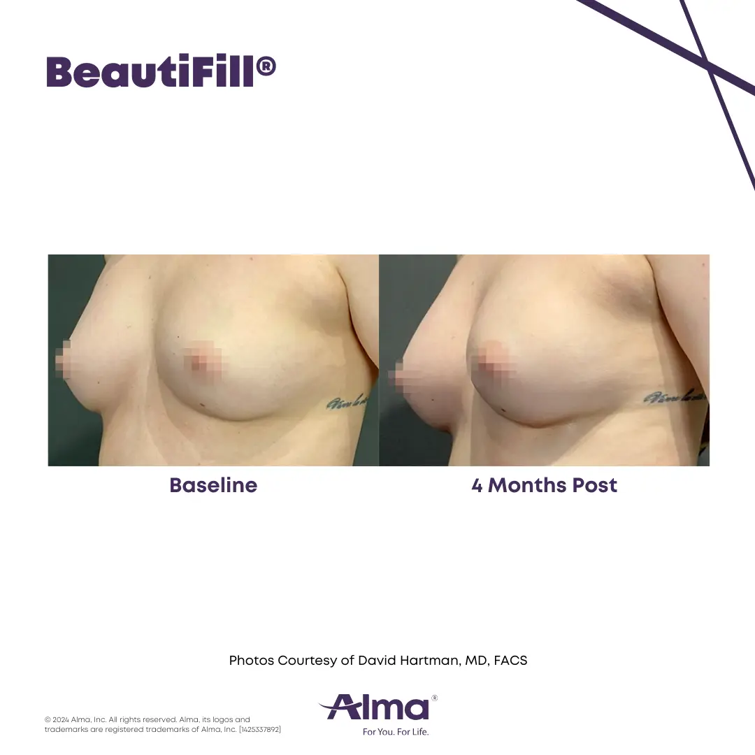 BeautiFill_BA_J