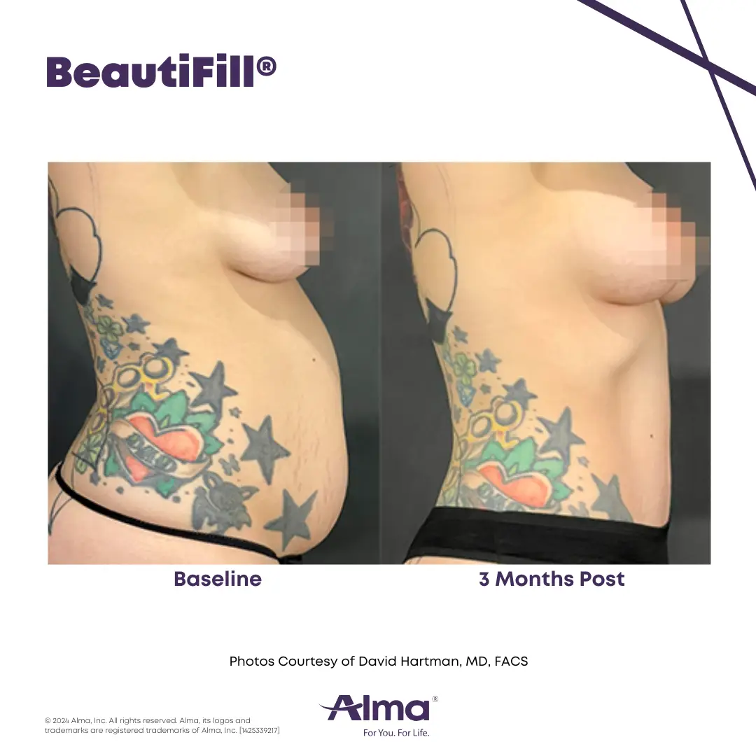 BeautiFill_BA_D