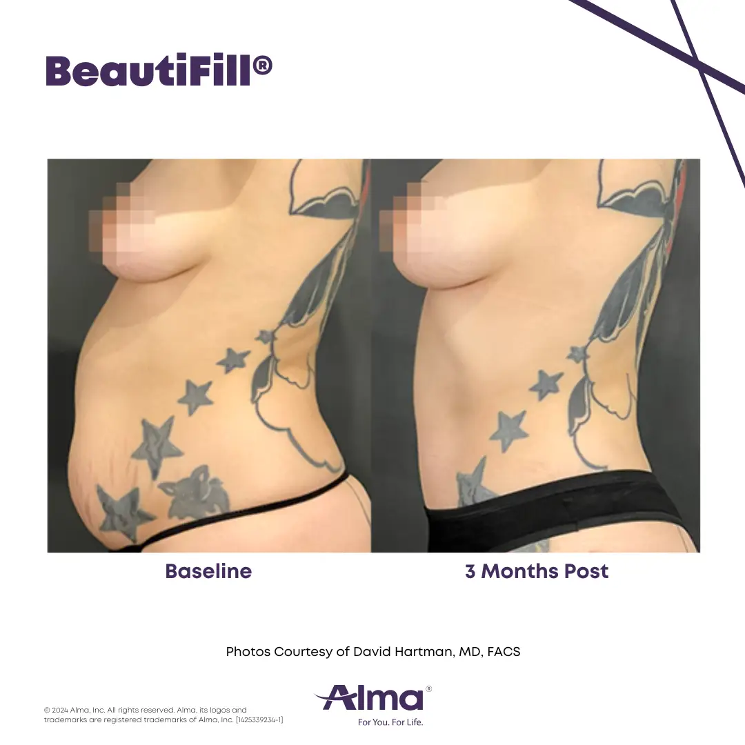 BeautiFill_BA_J