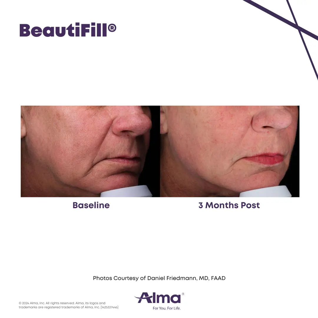 BeautiFill_BA_D