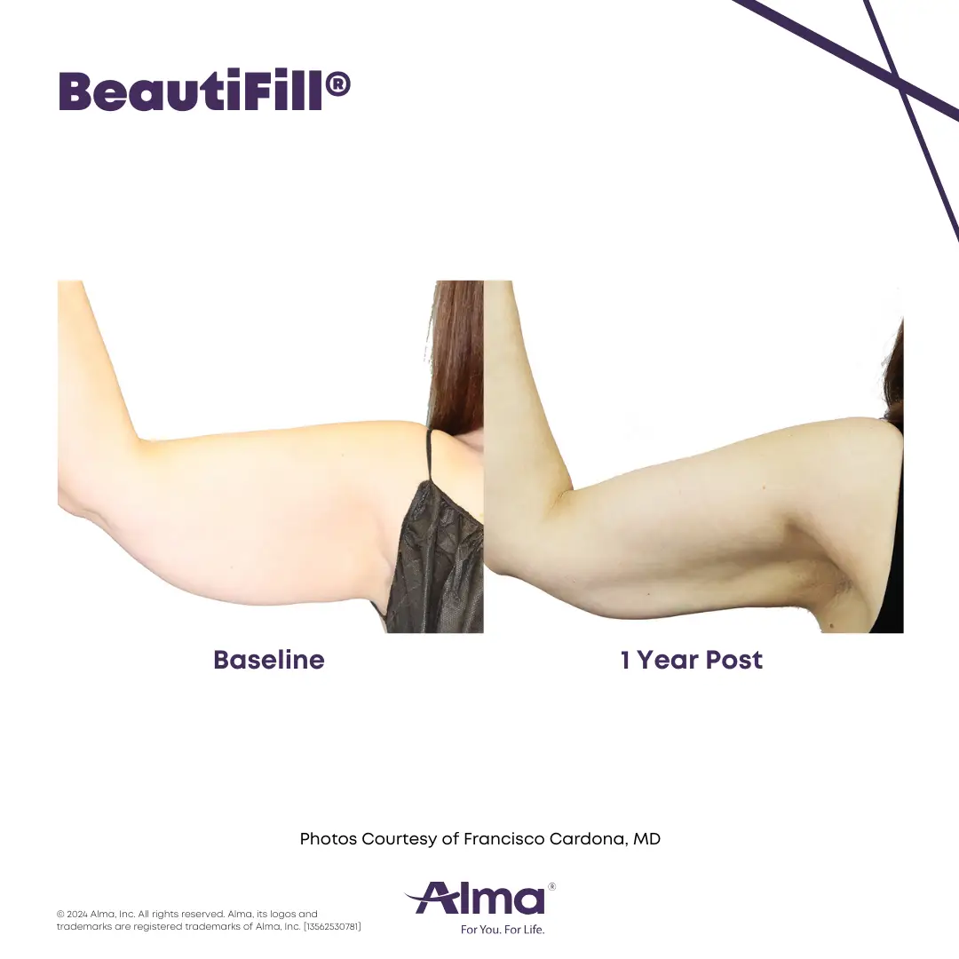 BeautiFill_BA_D