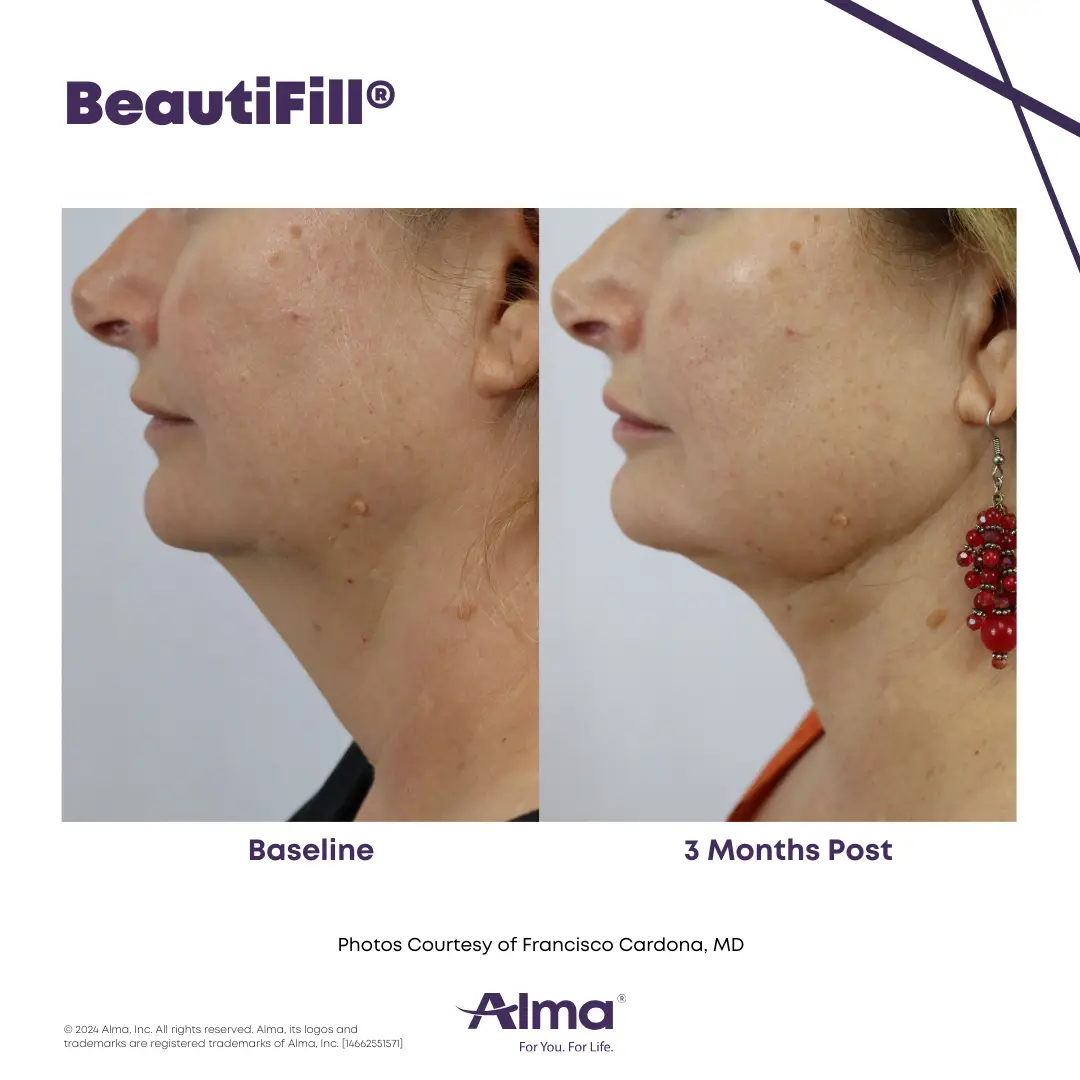 BeautiFill_BA_D