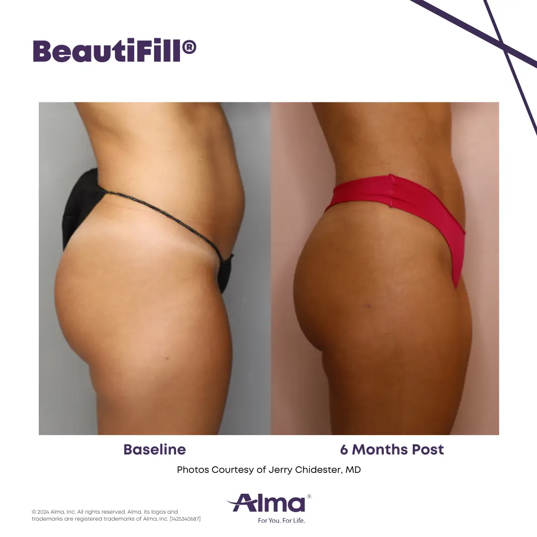 BeautiFill_BA_D