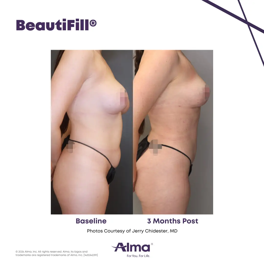 BeautiFill_BA_J