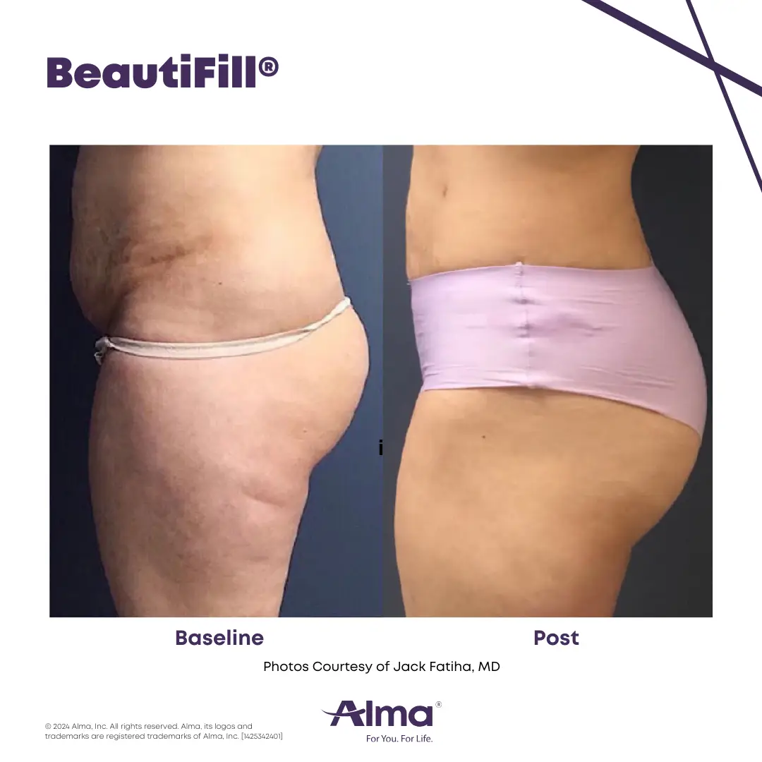 BeautiFill_BA_D