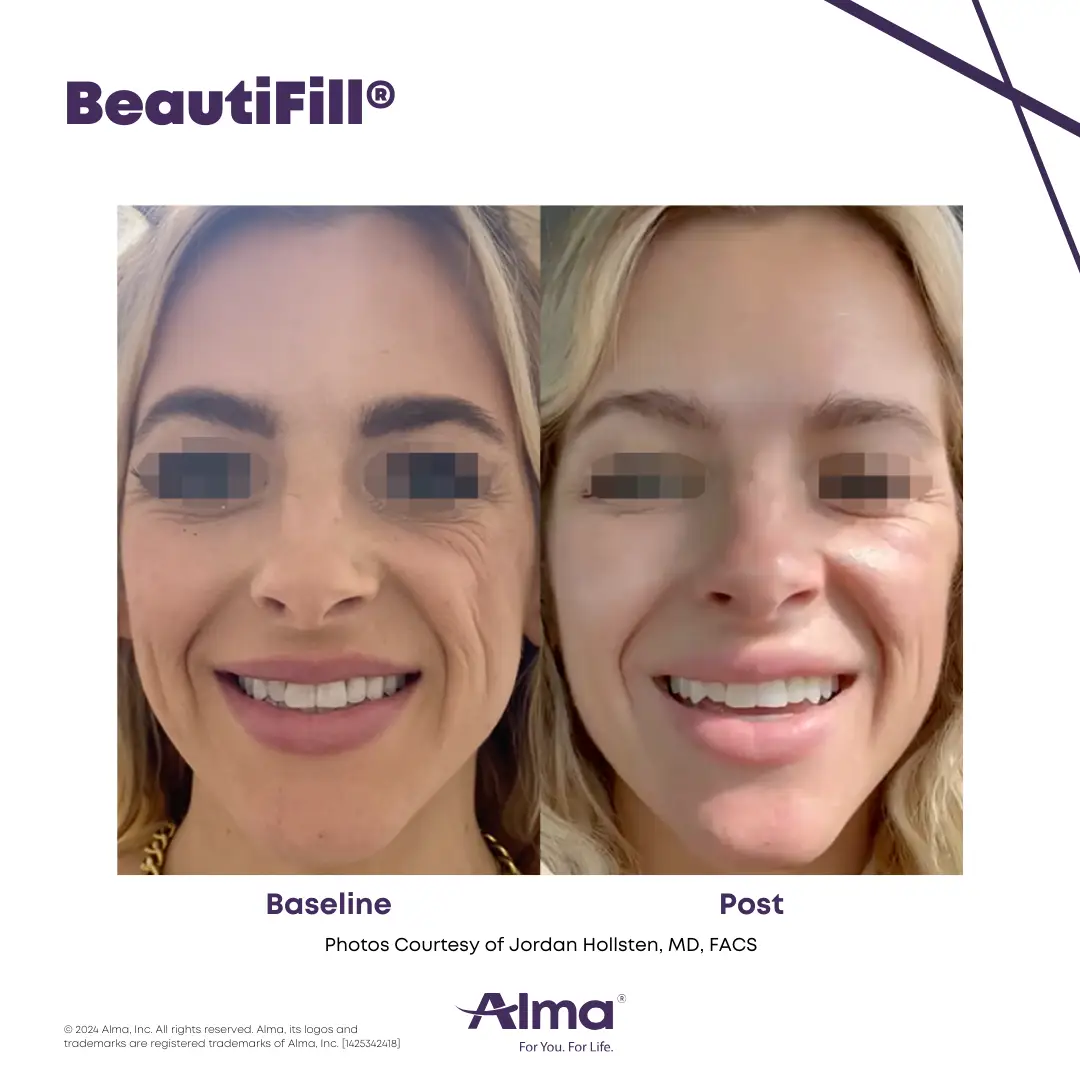 BeautiFill_BA_J