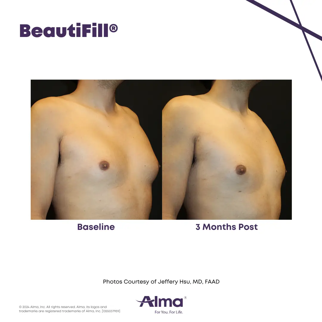 BeautiFill_BA_D