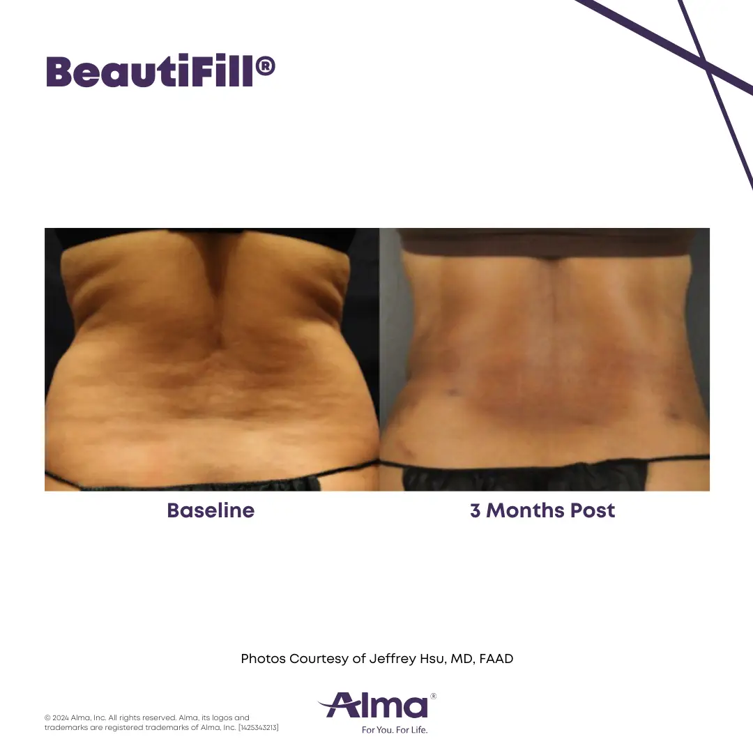 BeautiFill_BA_J