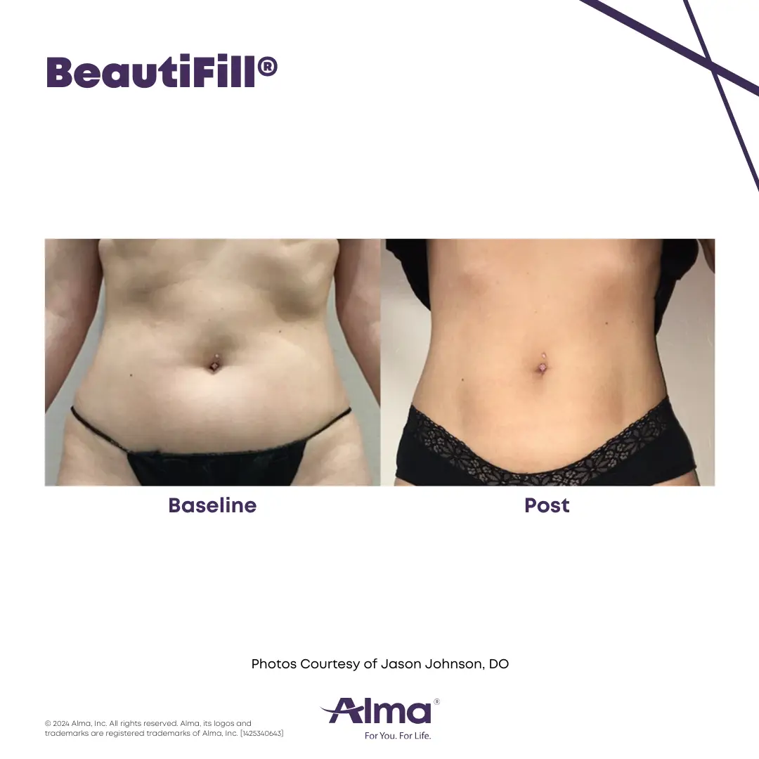 BeautiFill_BA_J