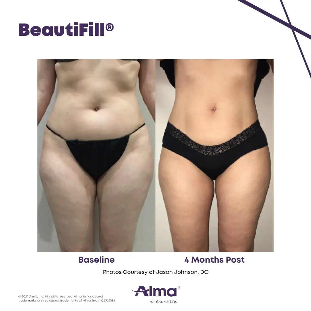 BeautiFill_BA_D