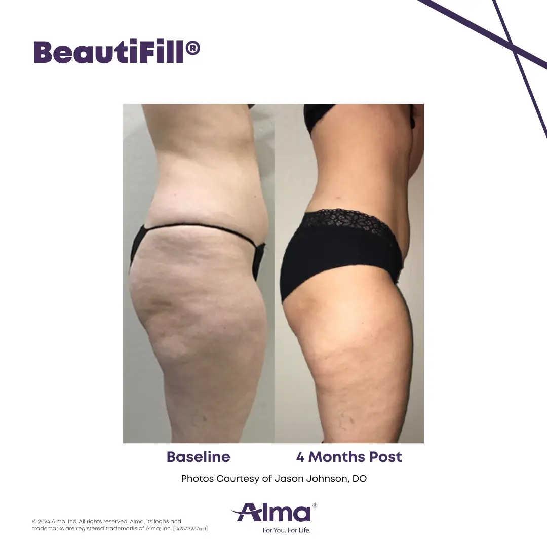 BeautiFill_BA_J