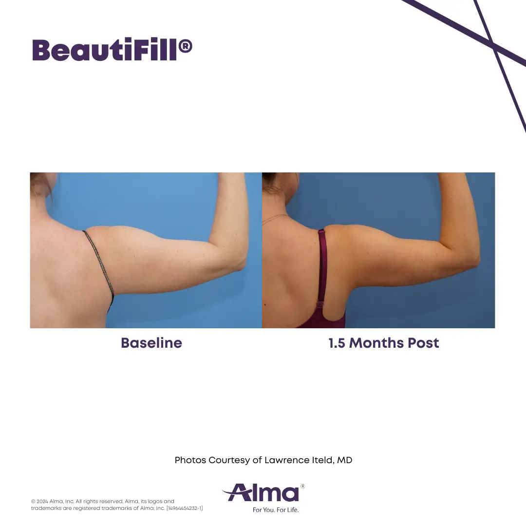 BeautiFill_