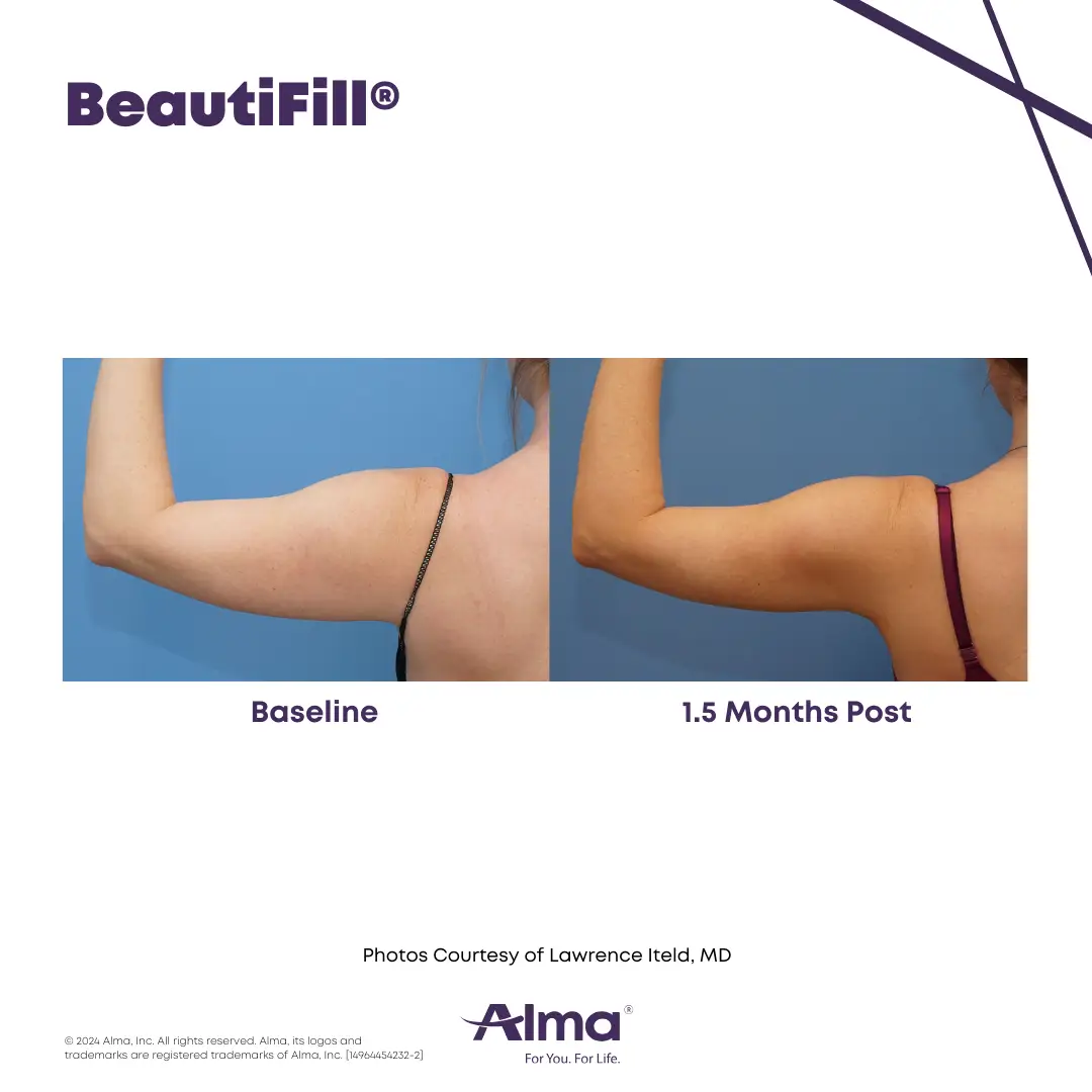 BeautiFill_BA_J