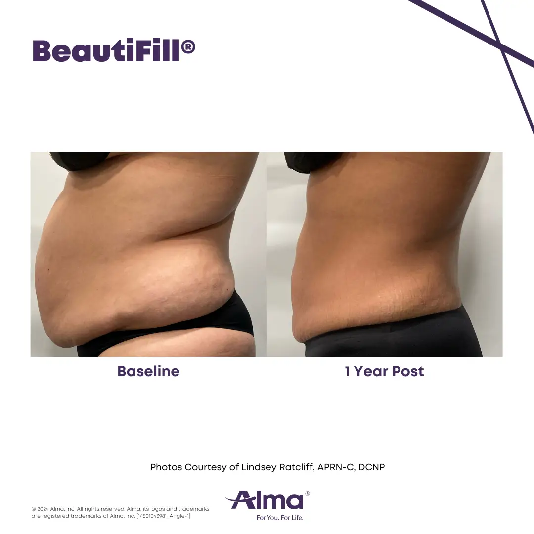 BeautiFill_BA_D