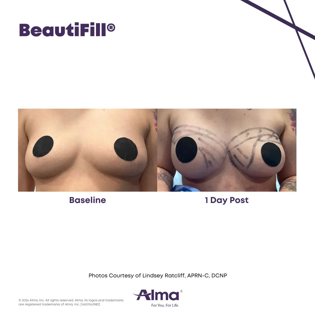 BeautiFill_BA_J