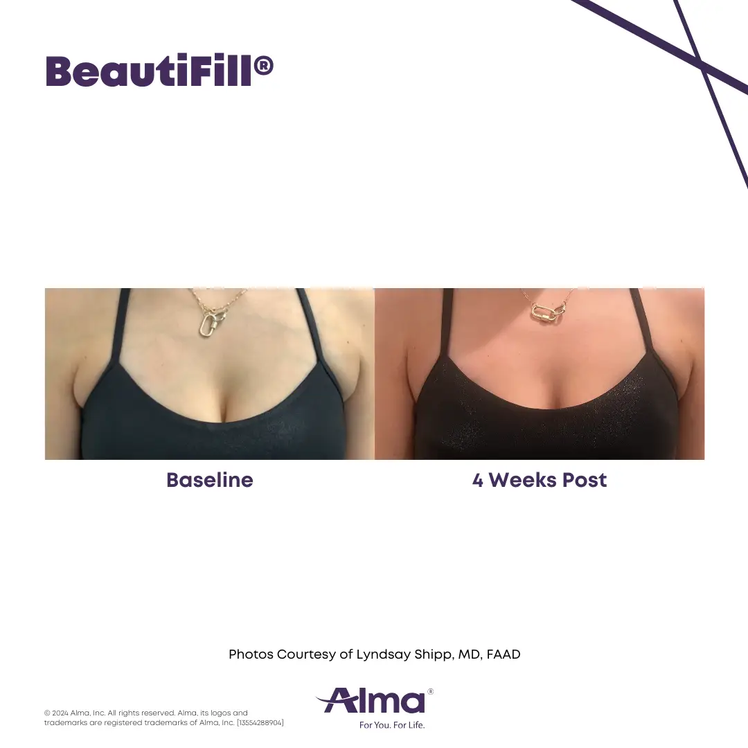 BeautiFill_BA_J