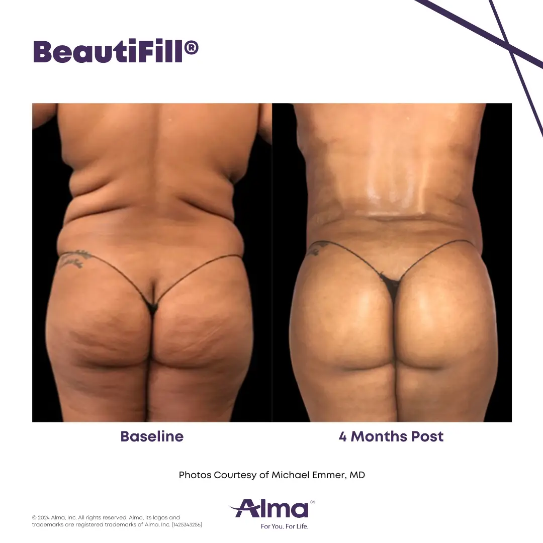 BeautiFill_BA_J