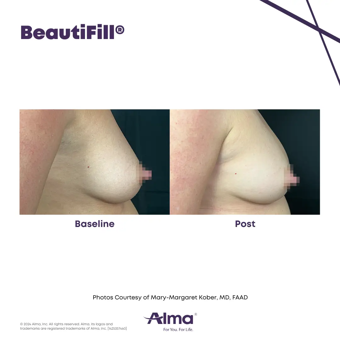 BeautiFill_BA_J