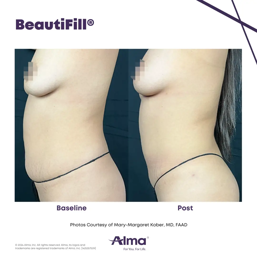 BeautiFill_BA_D