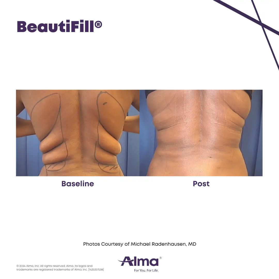 BeautiFill_BA_D