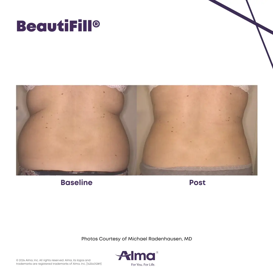 BeautiFill_BA_J