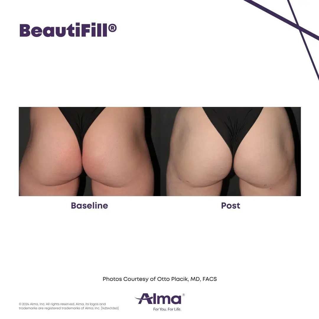 BeautiFill_BA_J