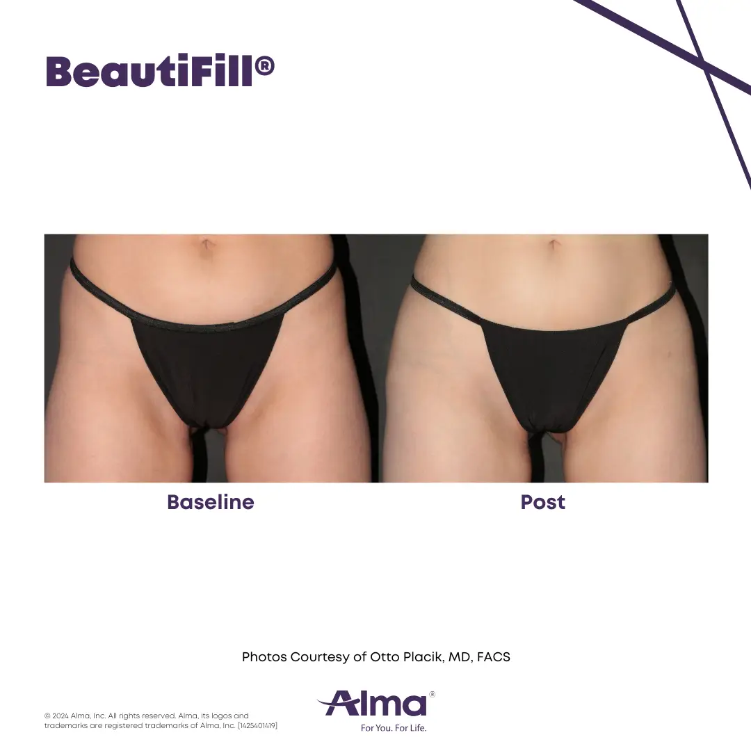 BeautiFill_BA_J