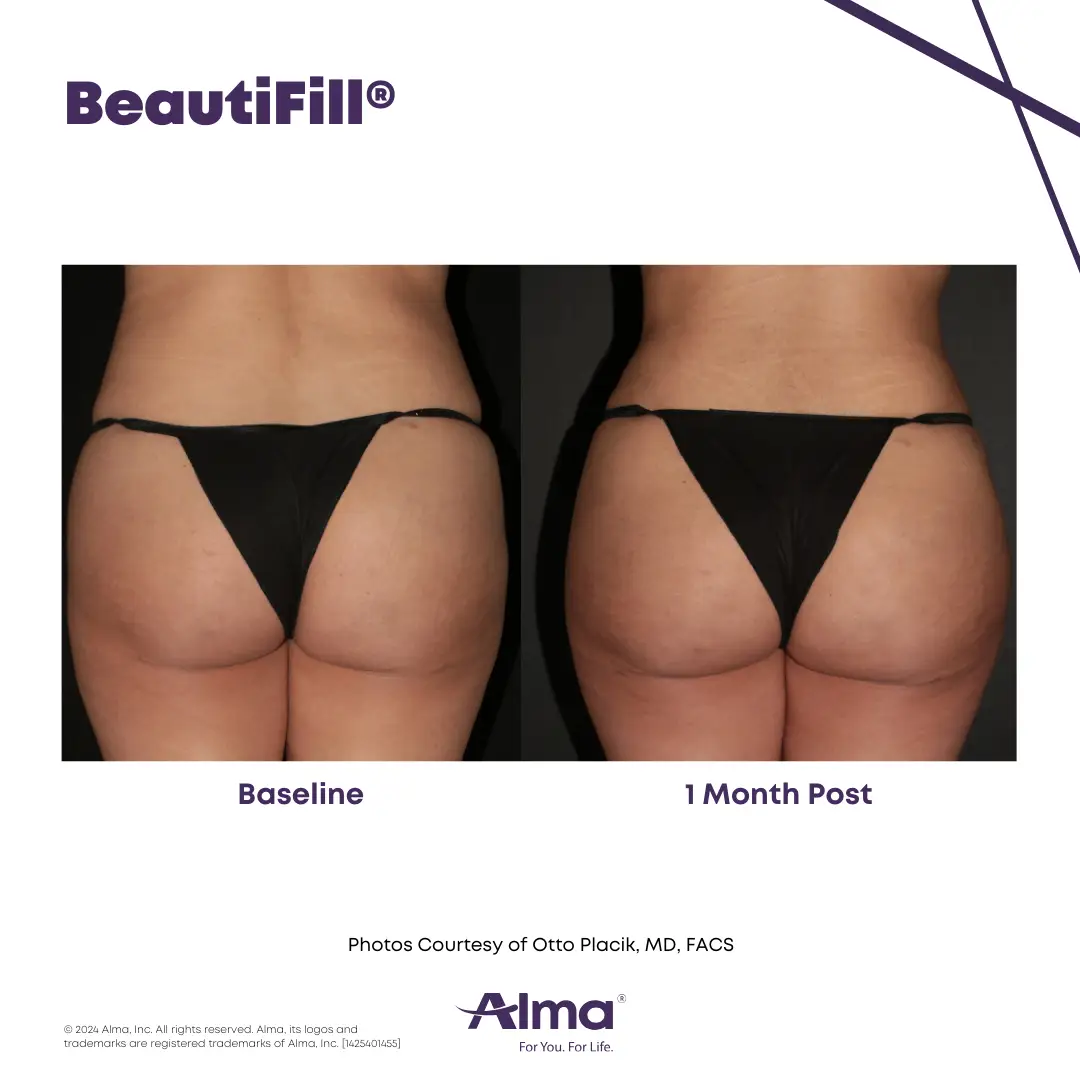 BeautiFill_BA_J