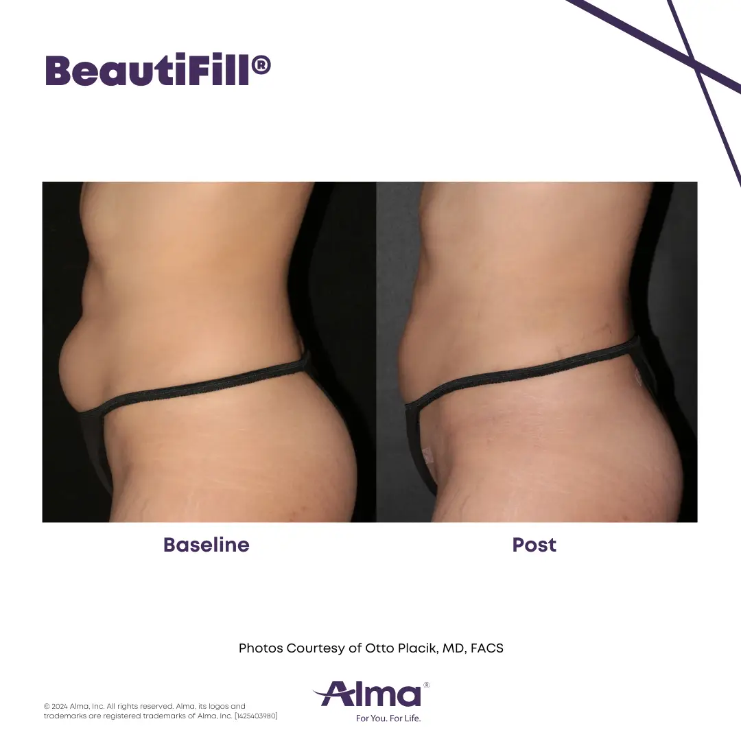 BeautiFill_BA_J