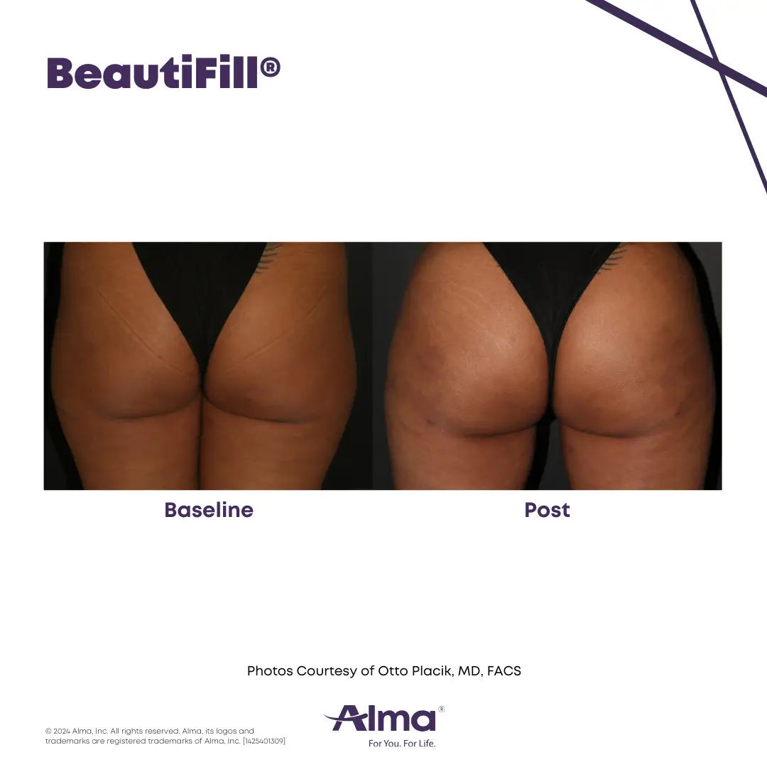 BeautiFill_BA_J