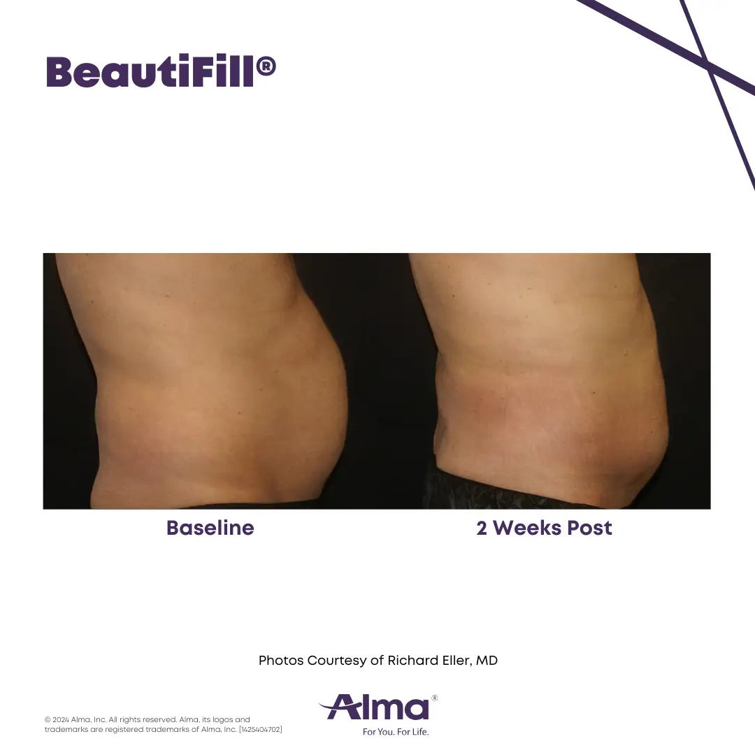 BeautiFill_BA_D