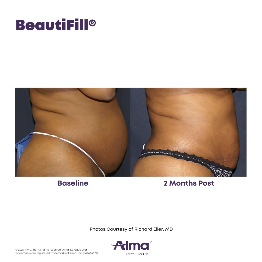 BeautiFill_BA_J