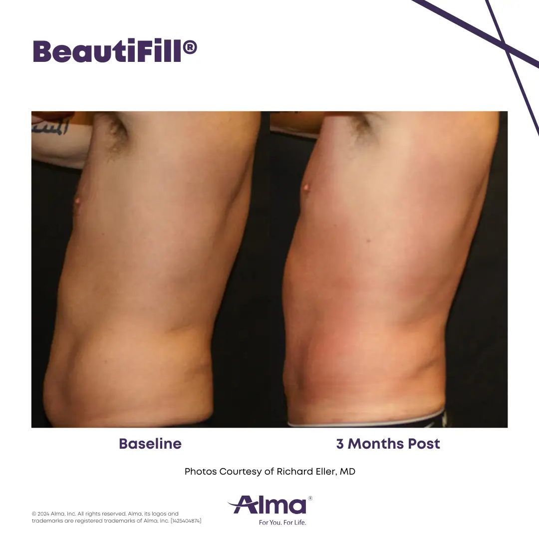 BeautiFill_BA_J