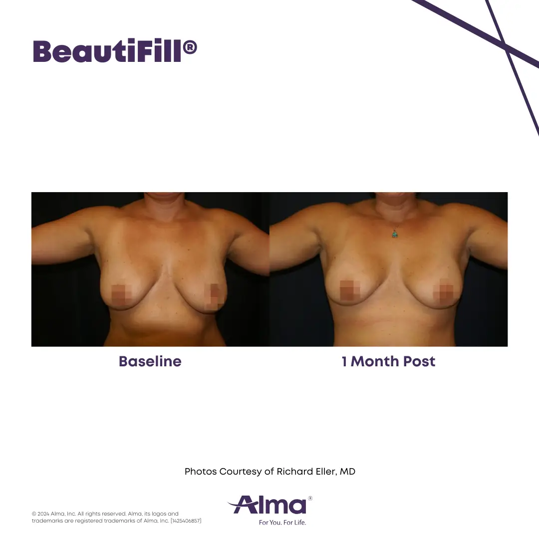 BeautiFill_BA_J
