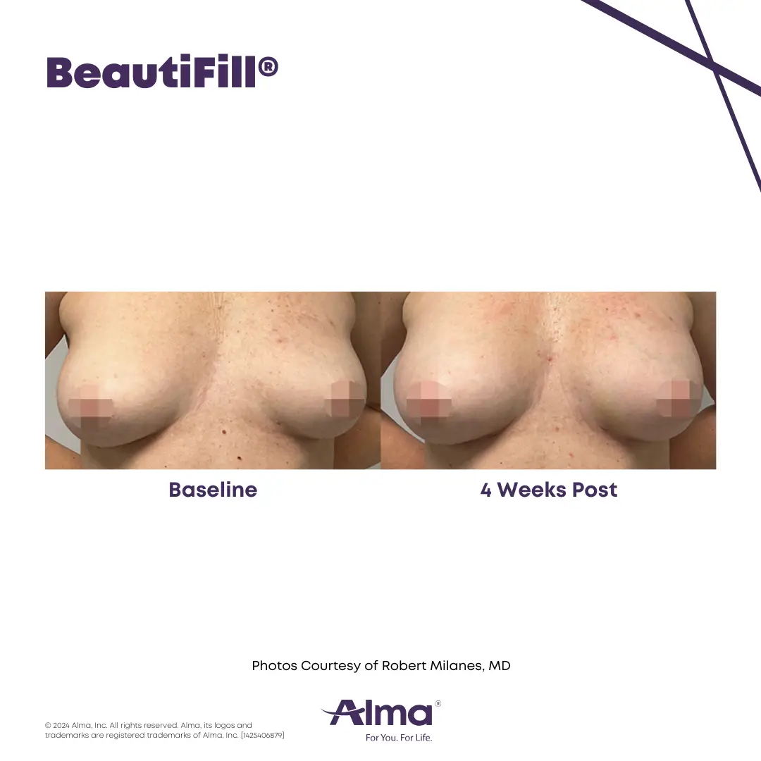 BeautiFill_BA_J