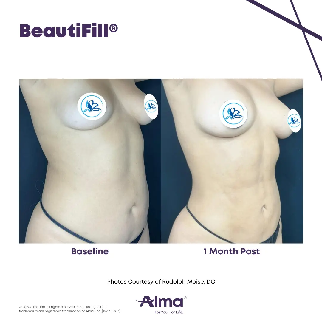 BeautiFill