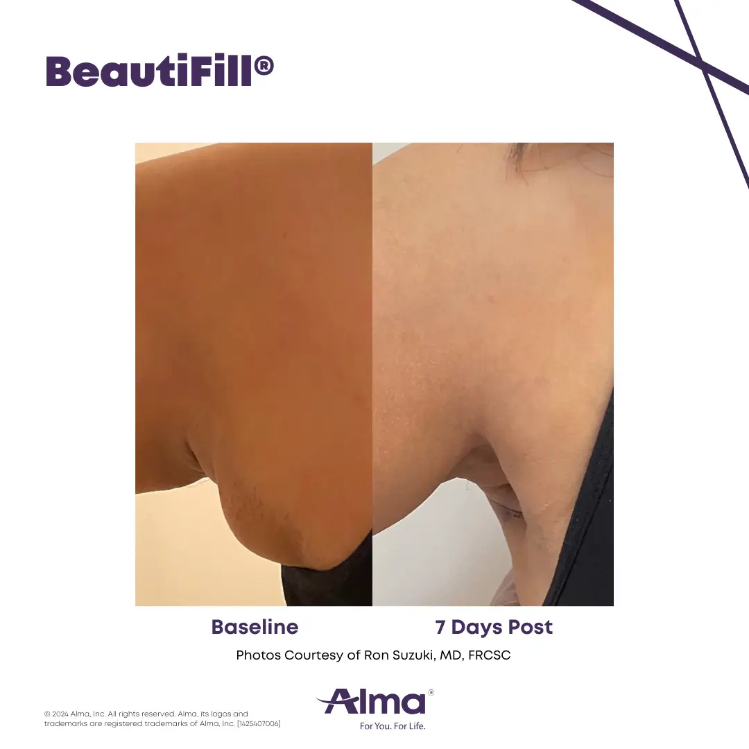 BeautiFill_BA_J