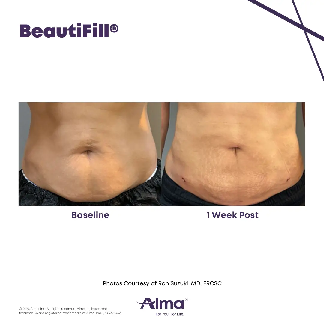BeautiFill_BA_J