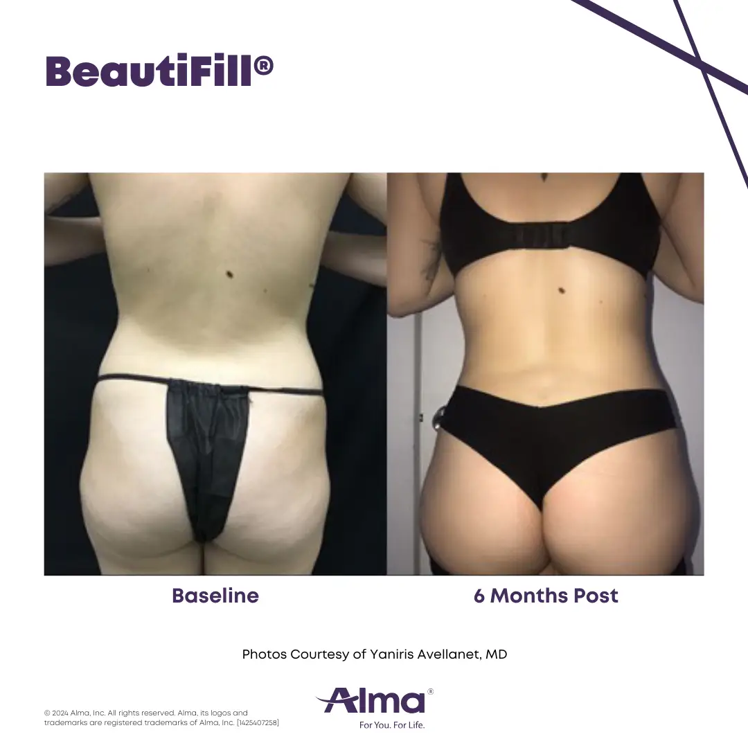 BeautiFill_BA_Y