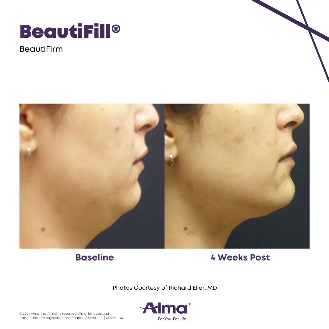 BeautiFill_BA_J