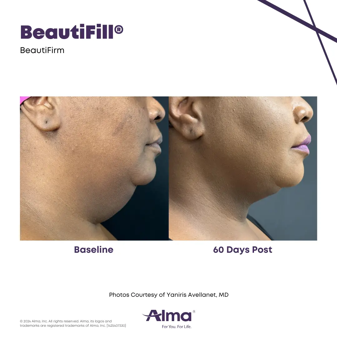 BeautiFill_BA_D